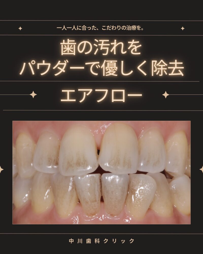 🦷✨ 歯の着色汚れ、気に…